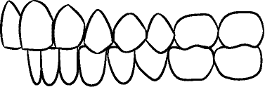 Line drawing of Intraoral Right Buccal Segment - Centric Relation, With Mirror