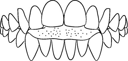 Line drawing of Intraoral Frontal View, showing Tongue Thrust, Without Mirror