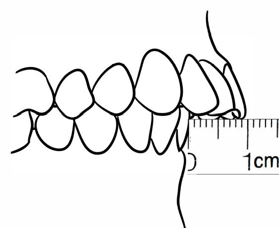 Line drawing of Intraoral Right Lateral View - Centric Occlusion, Showing Overjet, Without Mirror