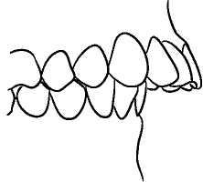 Line drawing of Intraoral Right Lateral View - Centric Relation, Showing Overjet, Without Mirror