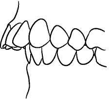 Line drawing of Intraoral Left Lateral View - Centric Occlusion, Showing Overjet, Without Mirror