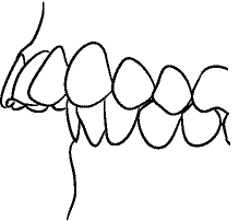 Line drawing of Intraoral Left Lateral View - Centric Relation, Showing Overjet, Without Mirror