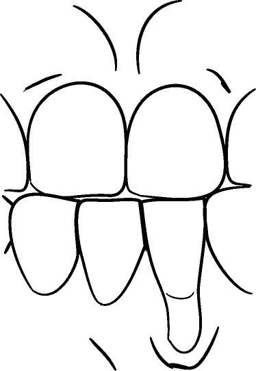 Line drawing of Intraoral - showing Gingival Recession (ISO tooth numbers)