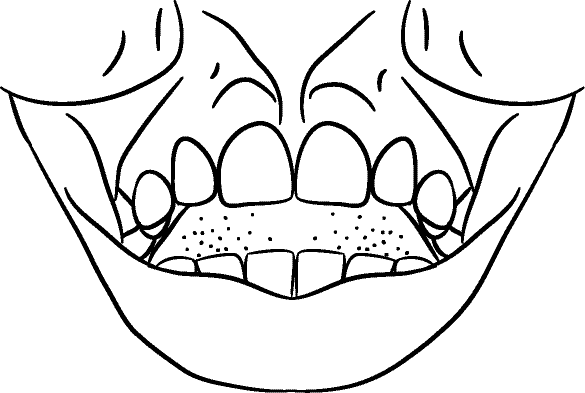 Line drawing of Intraoral - showing Frenum (ISO tooth numbers)