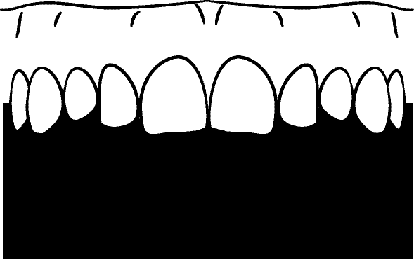 Line drawing of Intraoral - any photo using a photo accessory device such as a contraster to provide a solid background or black mirror ([modifier] is any set of IO modifier as specified above)